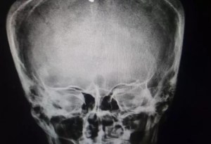 El peligroso reto viral que dejó con una fractura en el cráneo a adolescente en EEUU