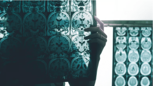 ¿Es posible determinar quién desarrollará la enfermedad de Alzheimer?