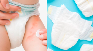 Bebés: ¿qué causa la dermatitis del pañal en ellos y cómo se puede tratar?